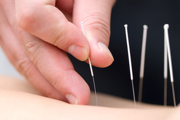 close up of hand inserting acupuncture needles