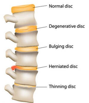 image of damaged spine
