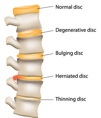 image of damaged spine