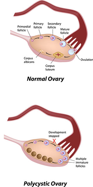 Polycystic Ovarian Syndrome - what is happening in the ovary