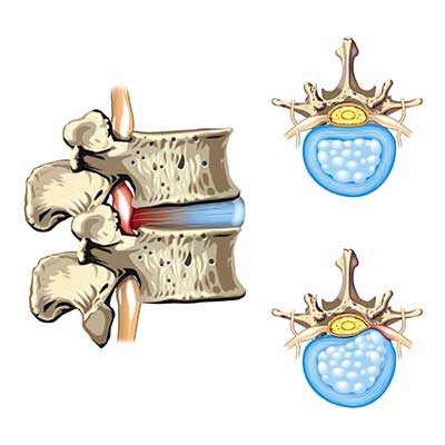 sciatica pain from nerve impingement