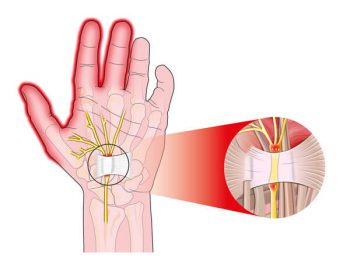 diagram of damage to medain nerve